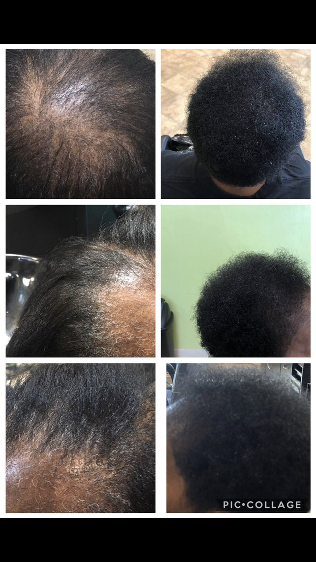 hair loss centers Delray Beach FL (1)